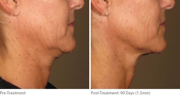Front view of Patient's before and after images of Neck Rejuvenation by Dr. Paul Vitenas in Houston, TX.