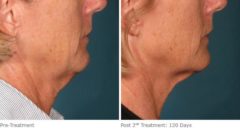 Ulthera Lift Before and After Photos in Houston, TX, Patient 8208