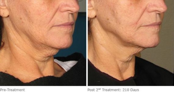 Ulthera Lift Before and After Photos in Houston, TX, Patient 8208