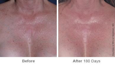Ulthera Lift Before and After Photos in Houston, TX, Patient 8221