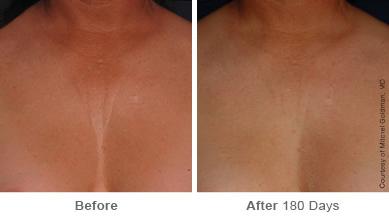 Ulthera Lift Before and After Photos in Houston, TX, Patient 8227