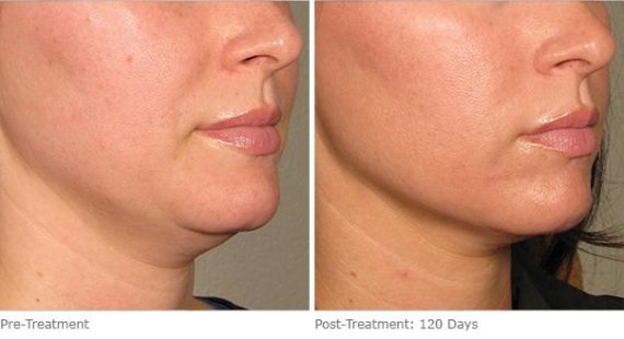 Ulthera Lift Before and After Photos in Houston, TX, Patient 8265
