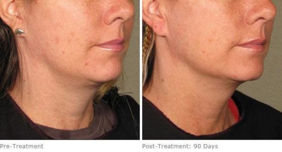 Ulthera Lift Before and After Photos in Houston, TX, Patient 8242
