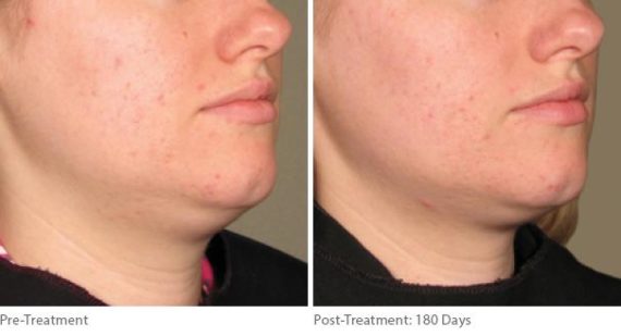 Ulthera Lift Before and After Photos in Houston, TX, Patient 8248