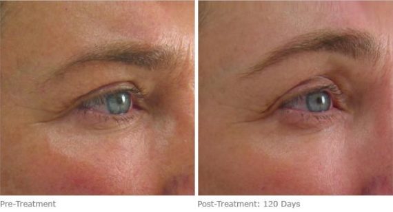 Ulthera Lift Before and After Photos in Houston, TX, Patient 8236