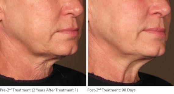 Ulthera Lift Before and After Photos in Houston, TX, Patient 8251