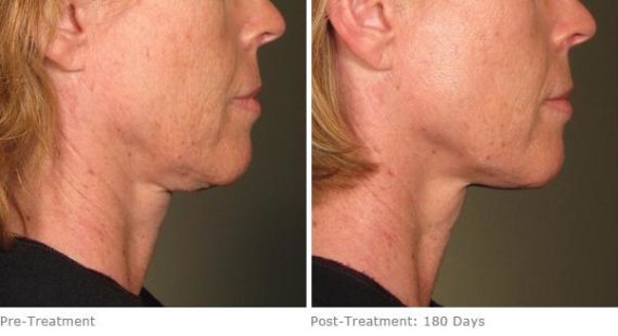 Ulthera Lift Before and After Photos in Houston, TX, Patient 8259