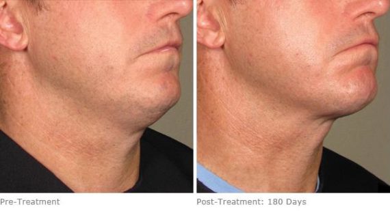 Ulthera Lift Before and After Photos in Houston, TX, Patient 8262