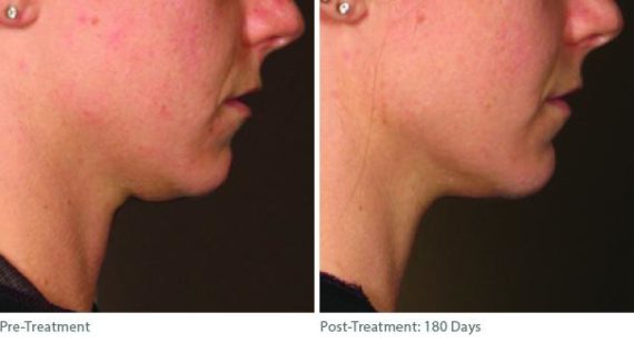 Ulthera Lift Before and After Photos in Houston, TX, Patient 8271
