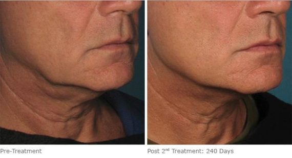 Ulthera Lift Before and After Photos in Houston, TX, Patient 8299