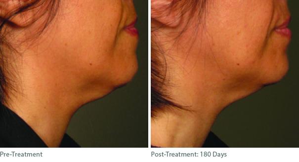 Ulthera Lift Before and After Photos in Houston, TX, Patient 8284
