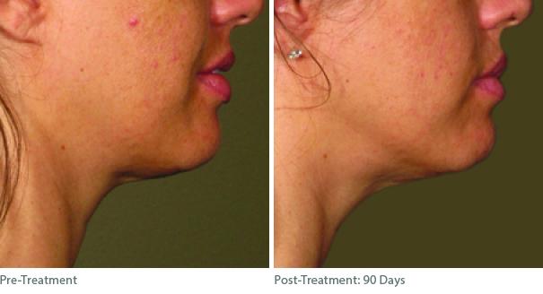 Ulthera Lift Before and After Photos in Houston, TX, Patient 8287