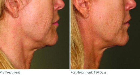 Ulthera Lift Before and After Photos in Houston, TX, Patient 8268