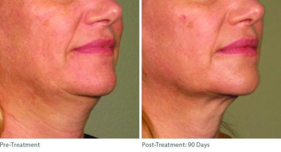 Ulthera Lift Before and After Photos in Houston, TX, Patient 8290