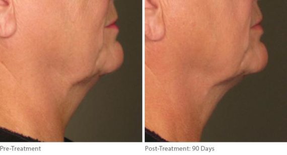 Ulthera Lift Before and After Photos in Houston, TX, Patient 8274