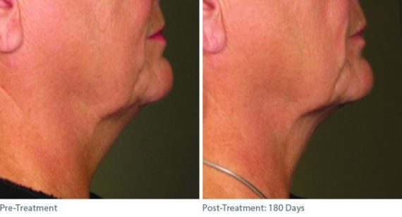 Ulthera Lift Before and After Photos in Houston, TX, Patient 8274