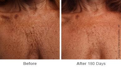 Ulthera Lift Before and After Photos in Houston, TX, Patient 8313