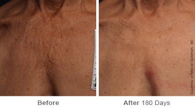 Ulthera Lift Before and After Photos in Houston, TX, Patient 8316