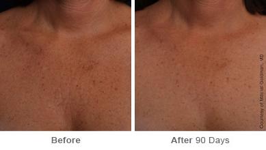 Ulthera Lift Before and After Photos in Houston, TX, Patient 8319