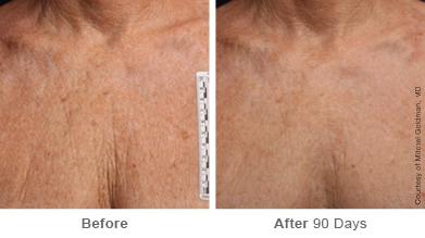 Ulthera Lift Before and After Photos in Houston, TX, Patient 8322