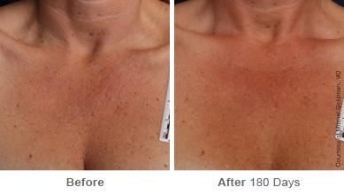 Ulthera Lift Before and After Photos in Houston, TX, Patient 8325