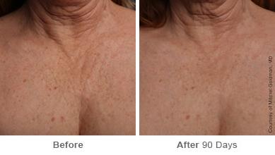 Ulthera Lift Before and After Photos in Houston, TX, Patient 8328