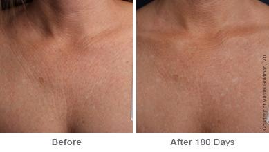 Ulthera Lift Before and After Photos in Houston, TX, Patient 8331