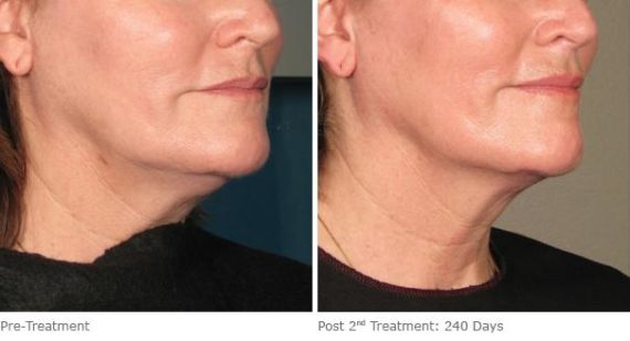 Ulthera Lift Before and After Photos in Houston, TX, Patient 8334