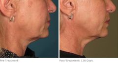 Ulthera Lift Before and After Photos in Houston, TX, Patient 8337