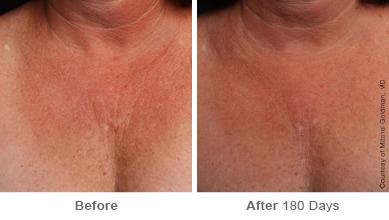 Ulthera Lift Before and After Photos in Houston, TX, Patient 8310