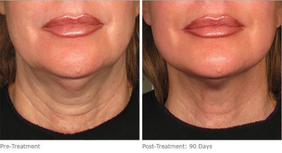 Ulthera Lift Before and After Photos in Houston, TX, Patient 8345