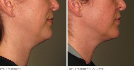 Ulthera Lift Before and After Photos in Houston, TX, Patient 8342