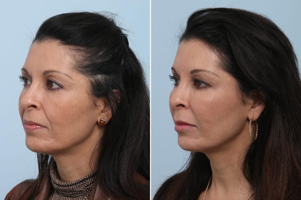 Voluma Before and After Photos in Houston, TX, Patient 8360