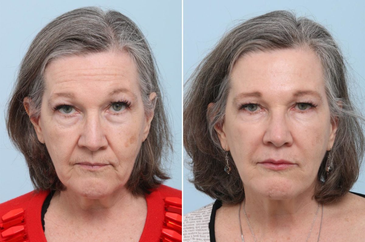 Voluma Before and After Photos in Houston, TX, Patient 8365