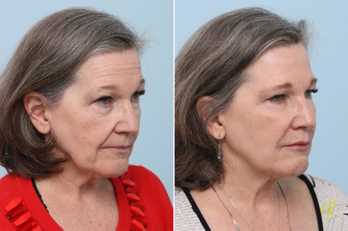 Voluma Before and After Photos in Houston, TX, Patient 8365