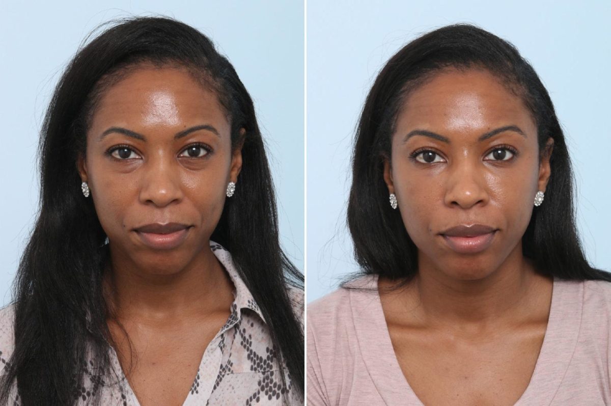 Voluma Before and After Photos in Houston, TX, Patient 8370