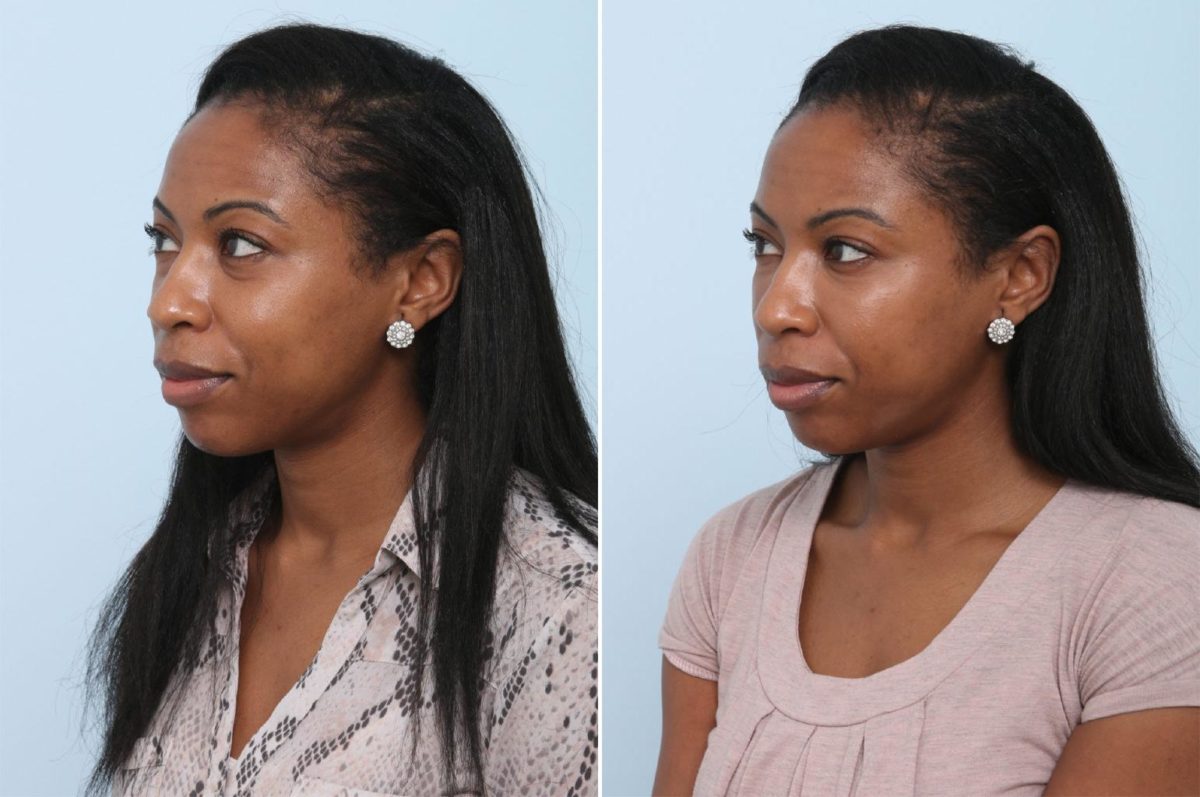 Voluma Before and After Photos in Houston, TX, Patient 8370