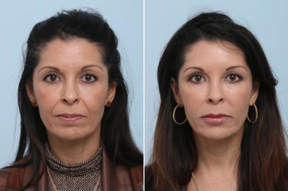 Voluma Before and After Photos in Houston, TX, Patient 8360
