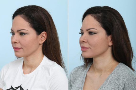 Voluma Before and After Photos in Houston, TX, Patient 8375