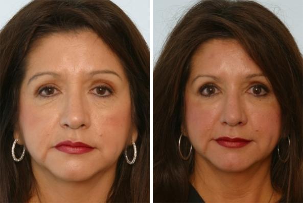 Restylane Lyft - Patient 1 - Before & After