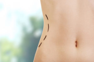 Can You Do CoolSculpting at Home?