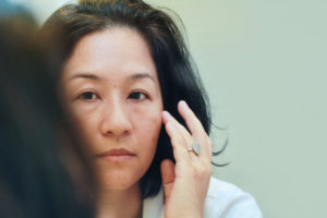 What is Melasma and What Can You Do About It?