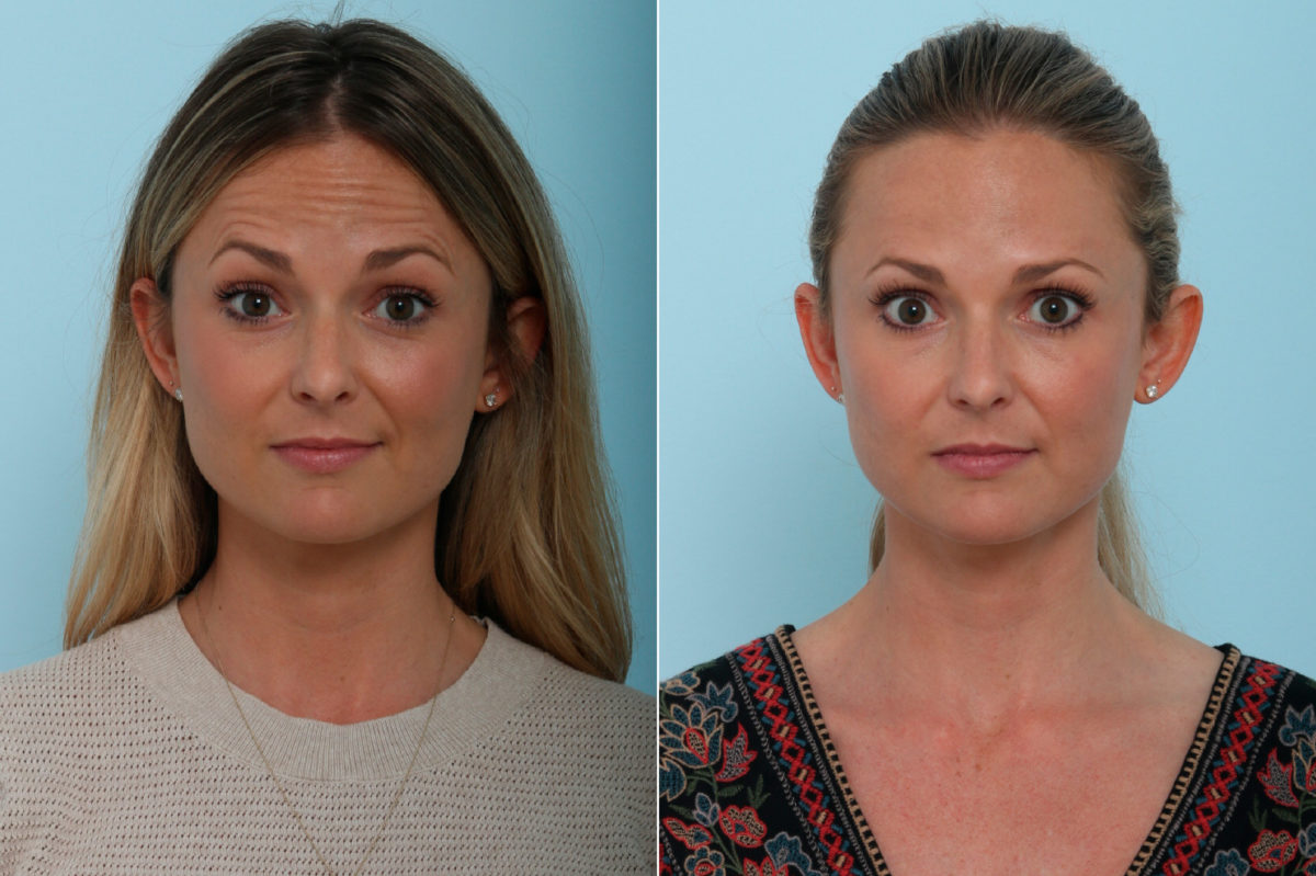 Botox® Cosmetic Before and After Photos in Houston, TX, Patient 9401