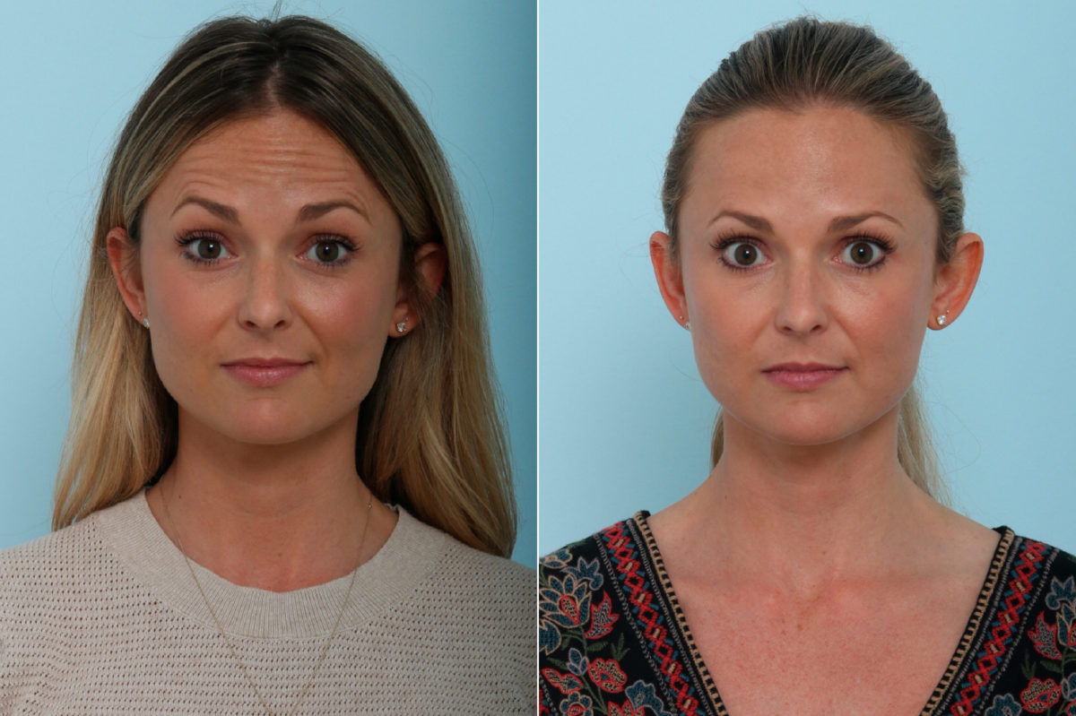 Botox® Cosmetic & Xeomin Before and After Photos in Houston, TX, Patient 9401