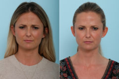 Botox® Cosmetic Before and After Photos in Houston, TX, Patient 9401