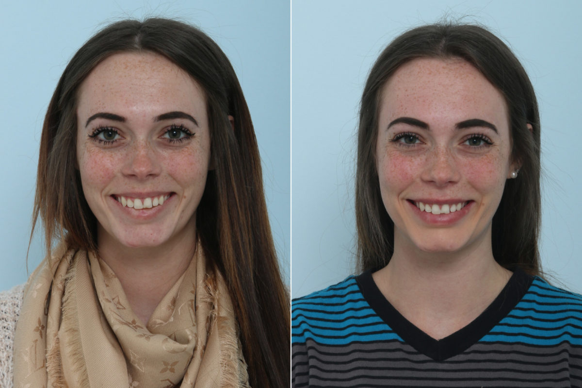 Botox® Cosmetic Before and After Photos in Houston, TX, Patient 9416