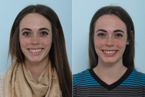 Botox® Cosmetic Before and After Photos in Houston, TX, Patient 9416