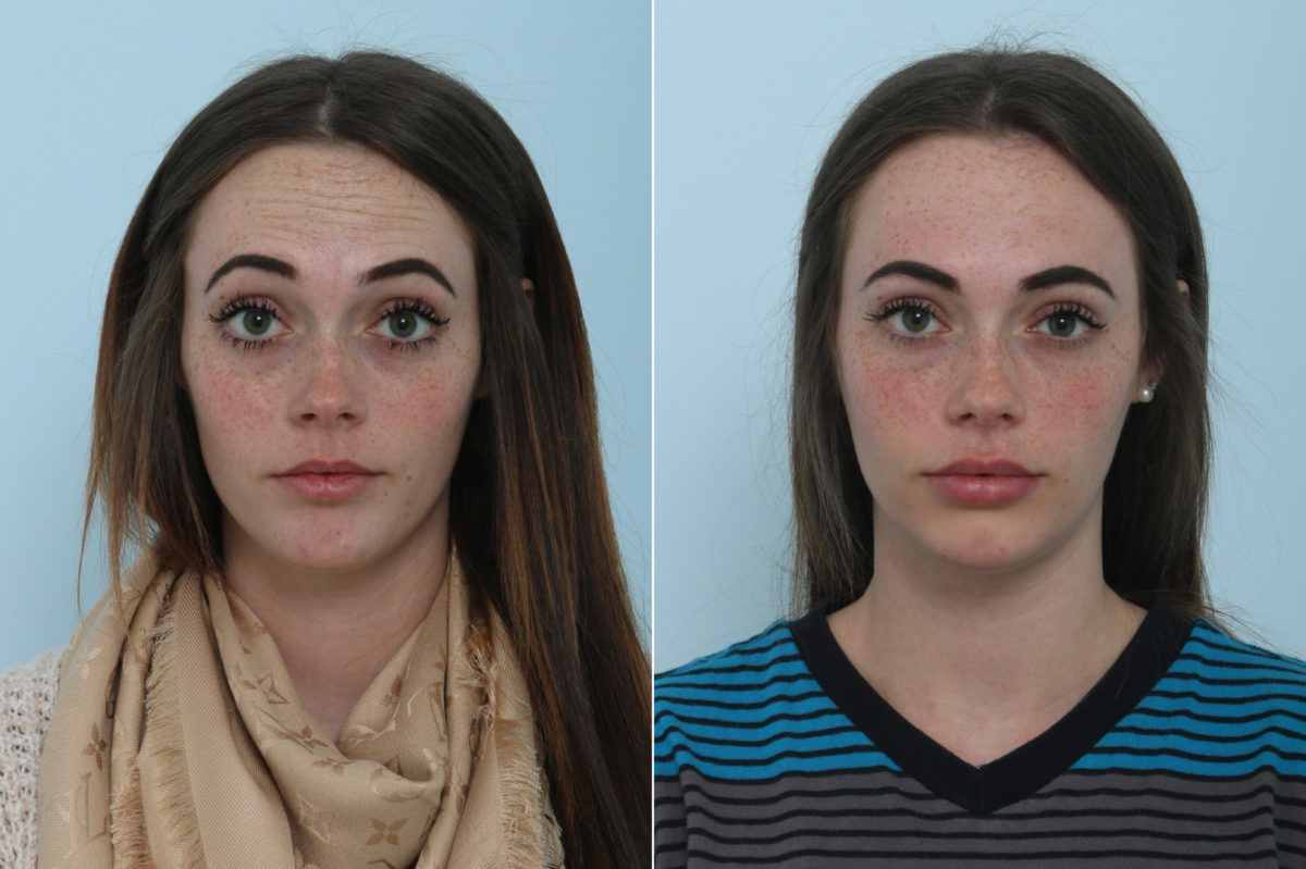 Botox® Cosmetic Before and After Photos in Houston, TX, Patient 9416
