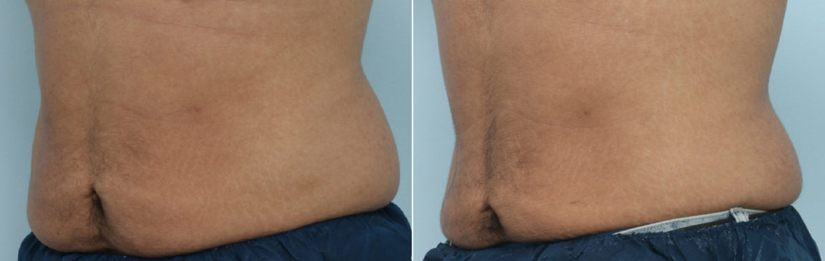 CoolSculpting Before and After Photos in Houston, TX, Patient 9461