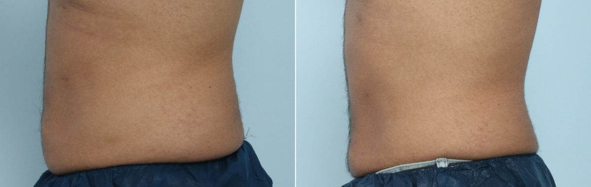 CoolSculpting Before and After Photos in Houston, TX, Patient 9461